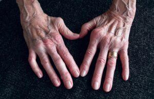 artrita reumatoida grad 3