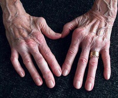 Artrita reumatoida (Poliartrita reumatoida) – ce este, simptome, tratamente naturiste, diagnostic